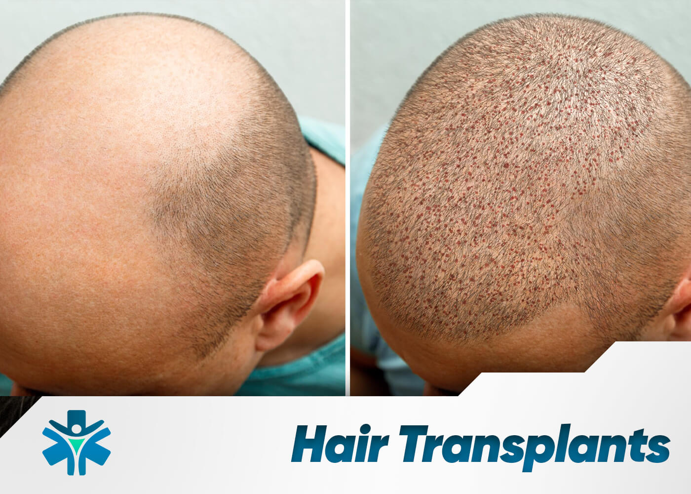 Hair Transplant
